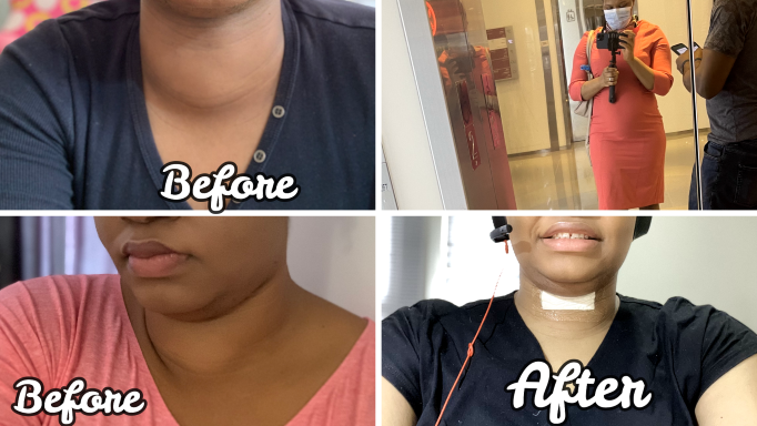 Total Thyroidectomy Story-How I Struggled With Goitre for Three Years